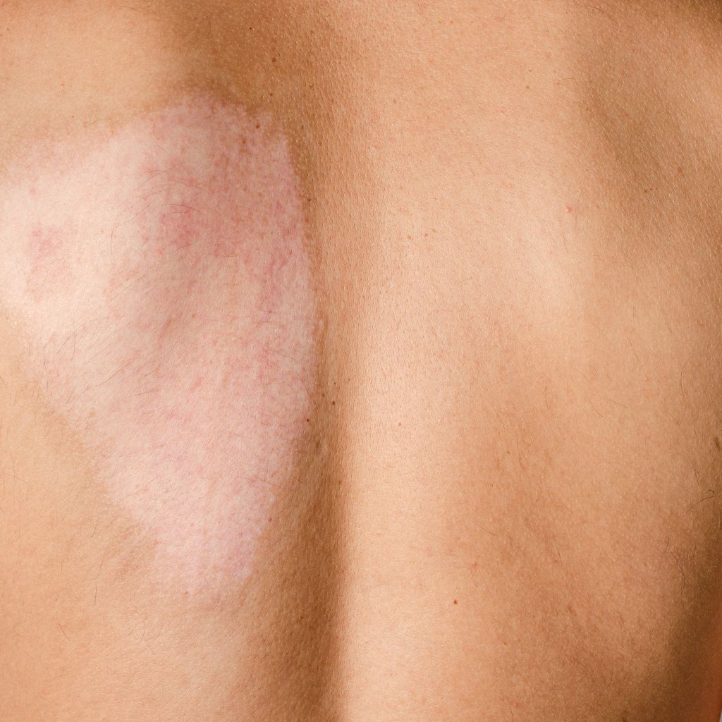 Replay of Live: B3 Scars Workshop: Understanding How Scars Disrupt Stability and Function