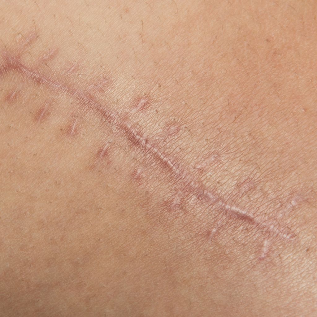 Replay of Live: B3 Scars Workshop: Understanding How Scars Disrupt Stability and Function