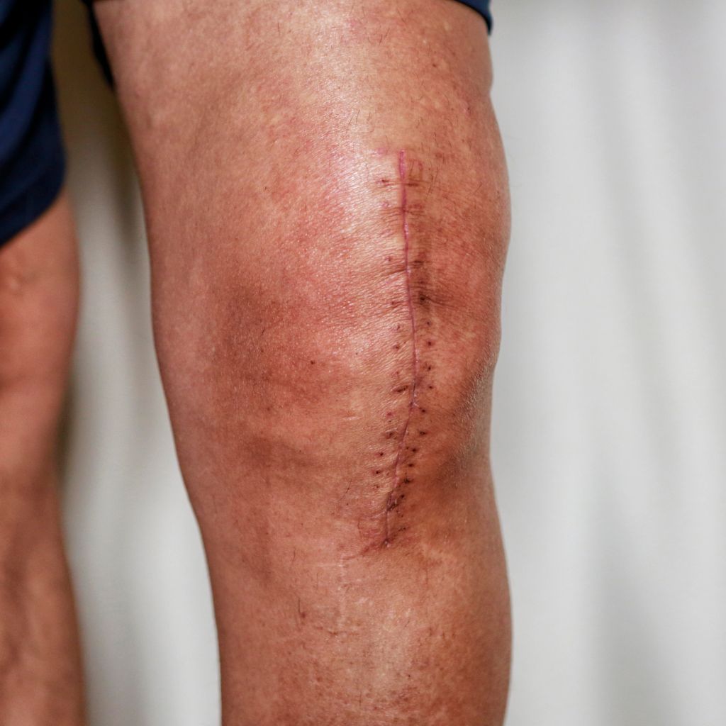 Replay of Live: B3 Scars Workshop: Understanding How Scars Disrupt Stability and Function