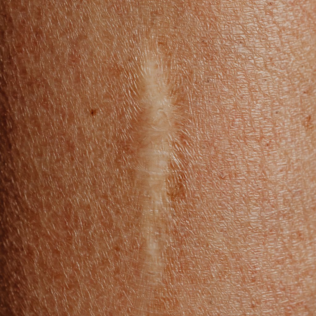 Replay of Live: B3 Scars Workshop: Understanding How Scars Disrupt Stability and Function