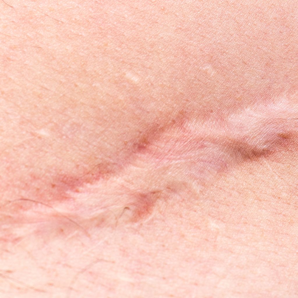 Replay of Live: B3 Scars Workshop: Understanding How Scars Disrupt Stability and Function