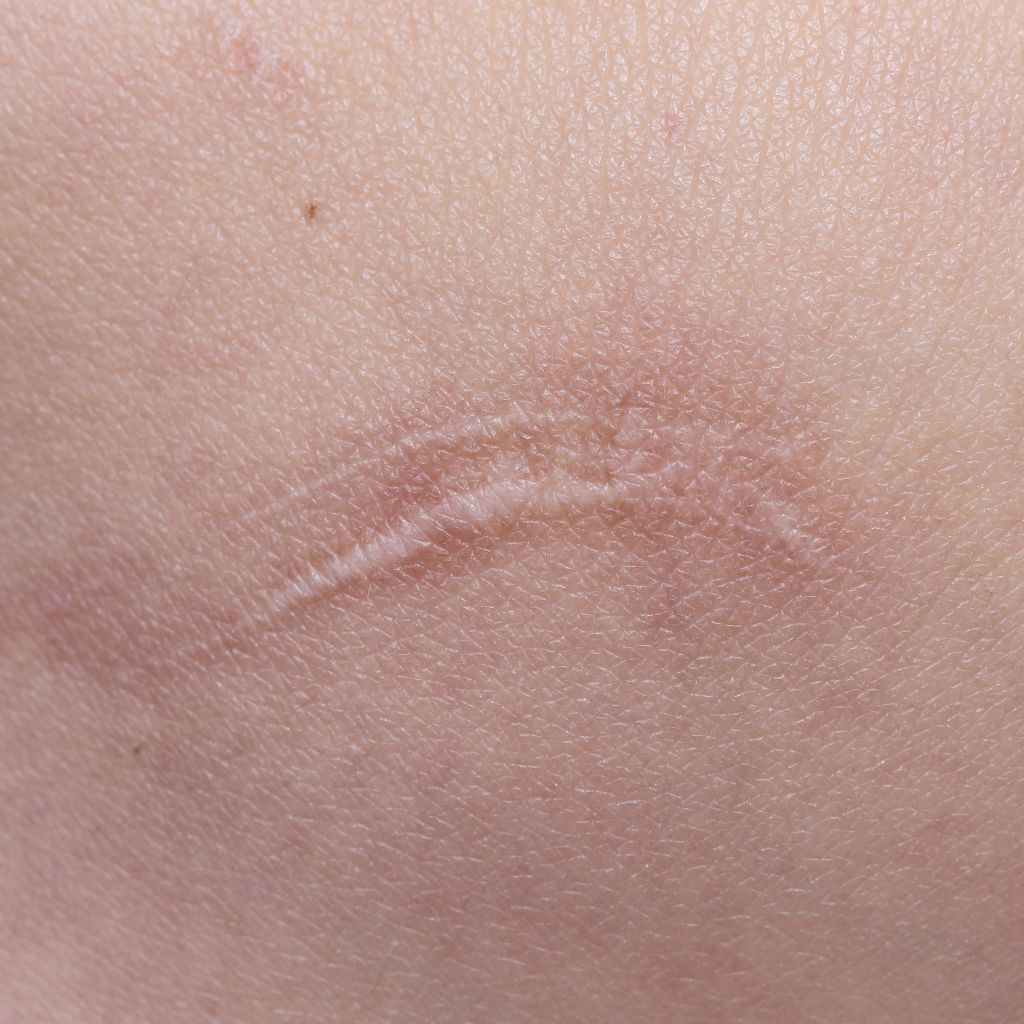 Replay of Live: B3 Scars Workshop: Understanding How Scars Disrupt Stability and Function