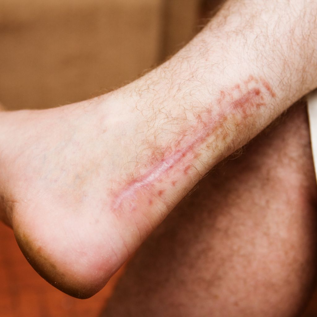 Replay of Live: B3 Scars Workshop: Understanding How Scars Disrupt Stability and Function