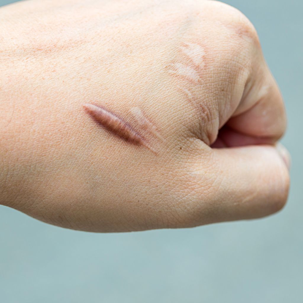 Replay of Live: B3 Scars Workshop: Understanding How Scars Disrupt Stability and Function