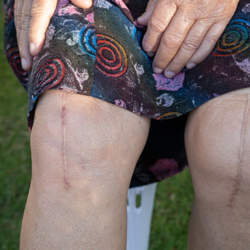 Replay of Live: B3 Scars Workshop: Understanding How Scars Disrupt Stability and Function