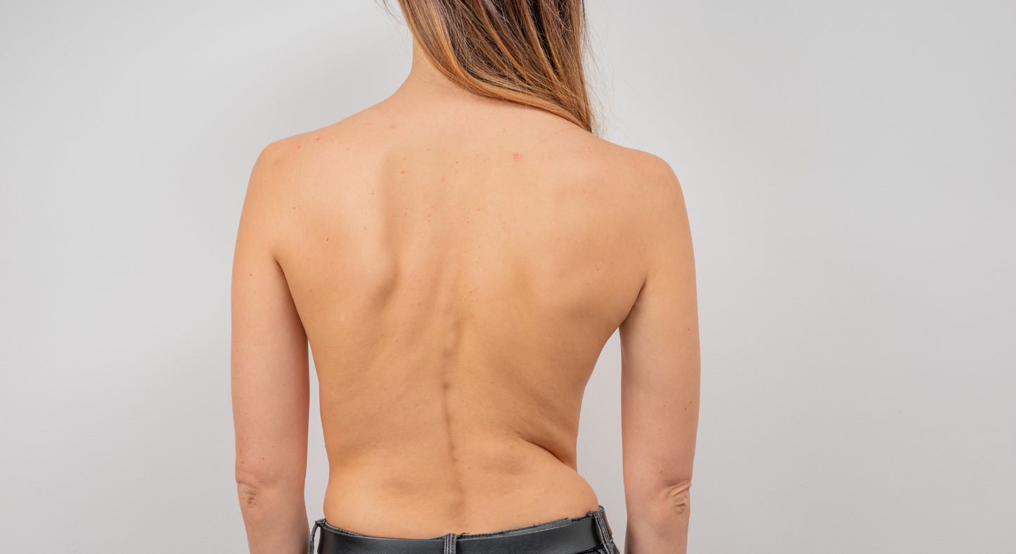 Live: Scoliosis Workshop